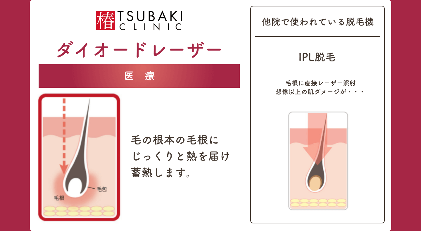 ダイオードレーザーは毛の根本の毛根にじっくりと熱を届け蓄熱します。