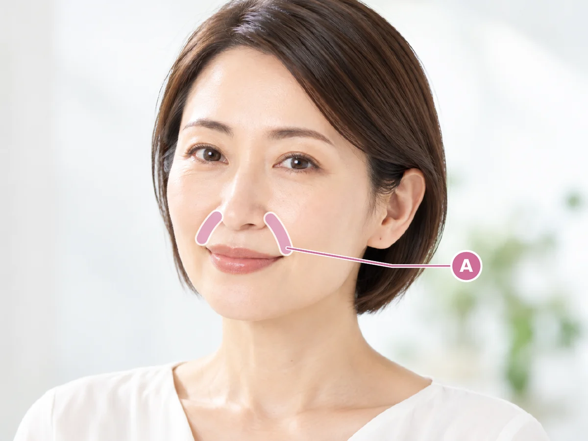 ほうれい線への注入部位のイメージ（モデル画像）