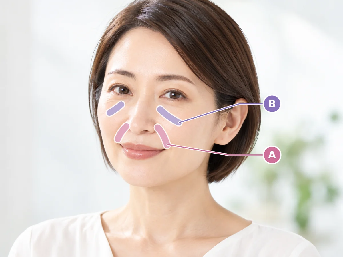 ほうれい線とゴルゴラインへの注入部位のイメージ（モデル画像）