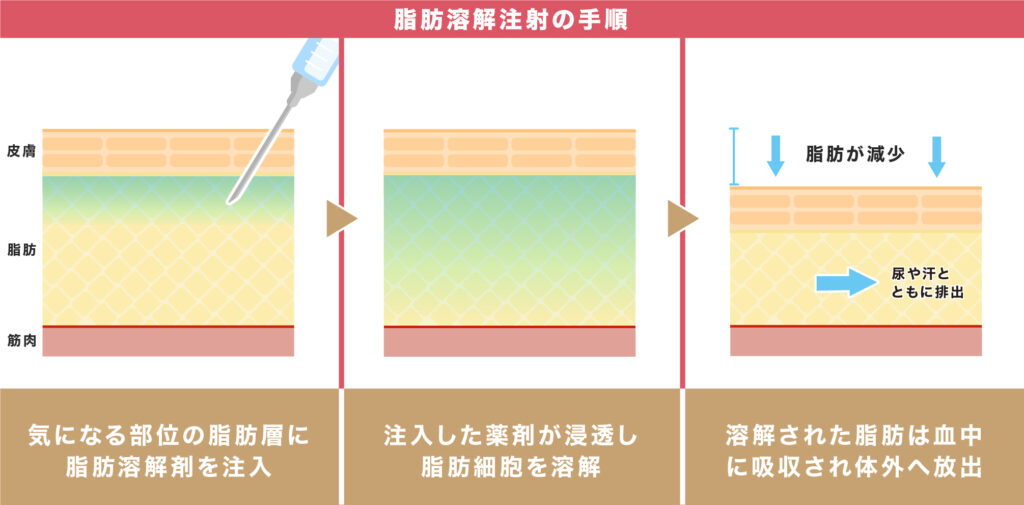 脂肪溶解注射は顔に何cc打てば効果ある？顔痩せするために必要な量と回数、ダウンタイムについても解説