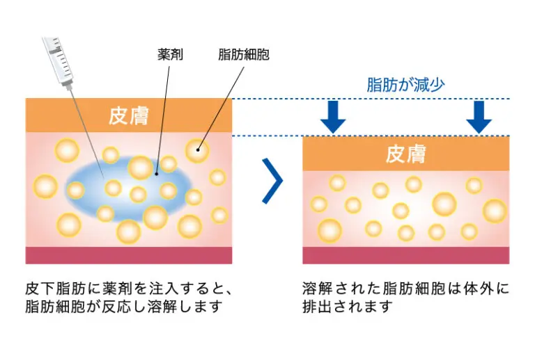 FatX coreとは？脂肪溶解注射の基本情報