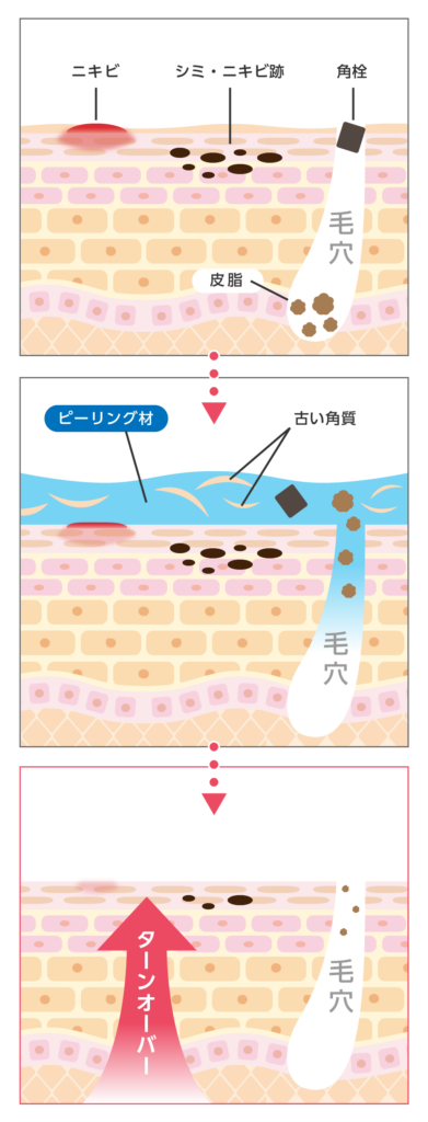 ケミカルピーリングはニキビ跡に効果ある？ニキビ跡の種類ごとに解説