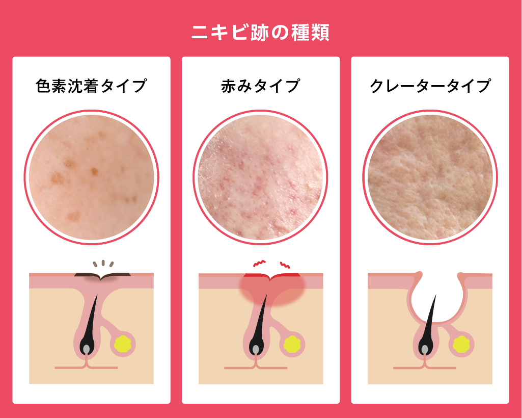 ケミカルピーリングはニキビ跡に効果ある？ニキビ跡の種類ごとに解説