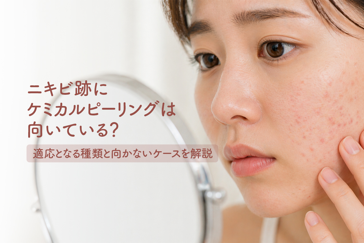 女性が、卓上ミラーを見ながら指先で頬に触れ、赤みやニキビ跡が見える肌の状態を確認している。「ニキビ跡にケミカルピーリングは向いている？適応となる種類と向かないケースを解説」というタイトルの入った美容医療のメインビジュアル。