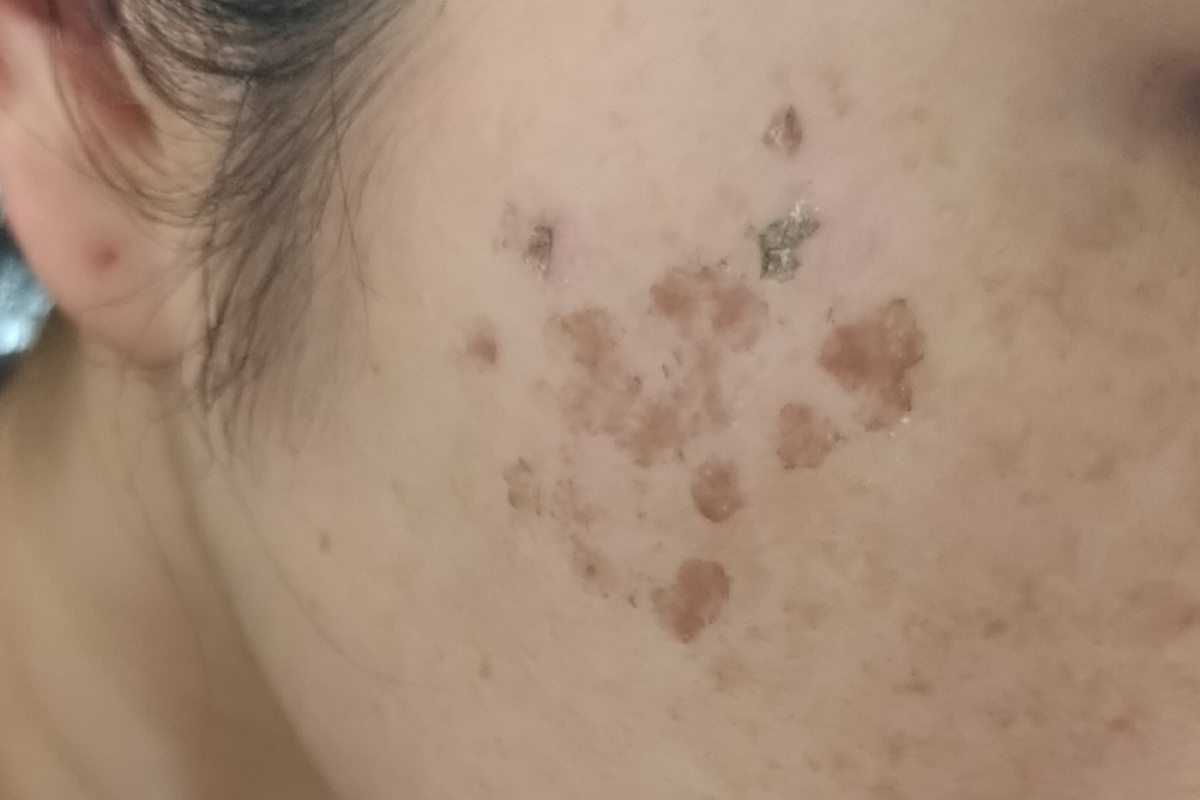 実際にフォトフェイシャルを受けてシミがかさぶたとして剥がれてきた状態の女性の頬の様子の写真。シミは濃くなっており、一部のシミはかさぶたのように剥がれかけている。