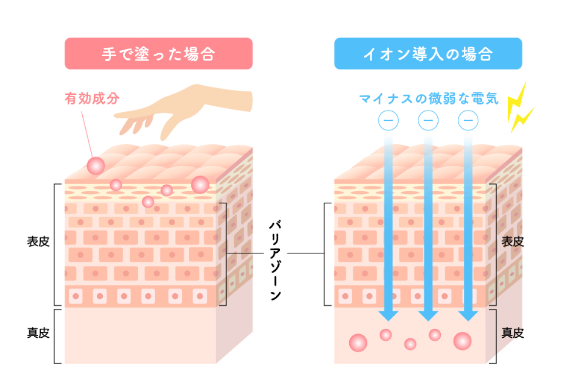 肌への美白などの有効成分を手で塗った場合とイオン導入で入れた場合の浸透の違いを表したイラスト。肌の断面図のイラストに、手で塗った場合は表皮のバリアゾーンを通過しないがイオン導入の場合はバリアゾーンを通過して真皮にまで到達している様子を表している。