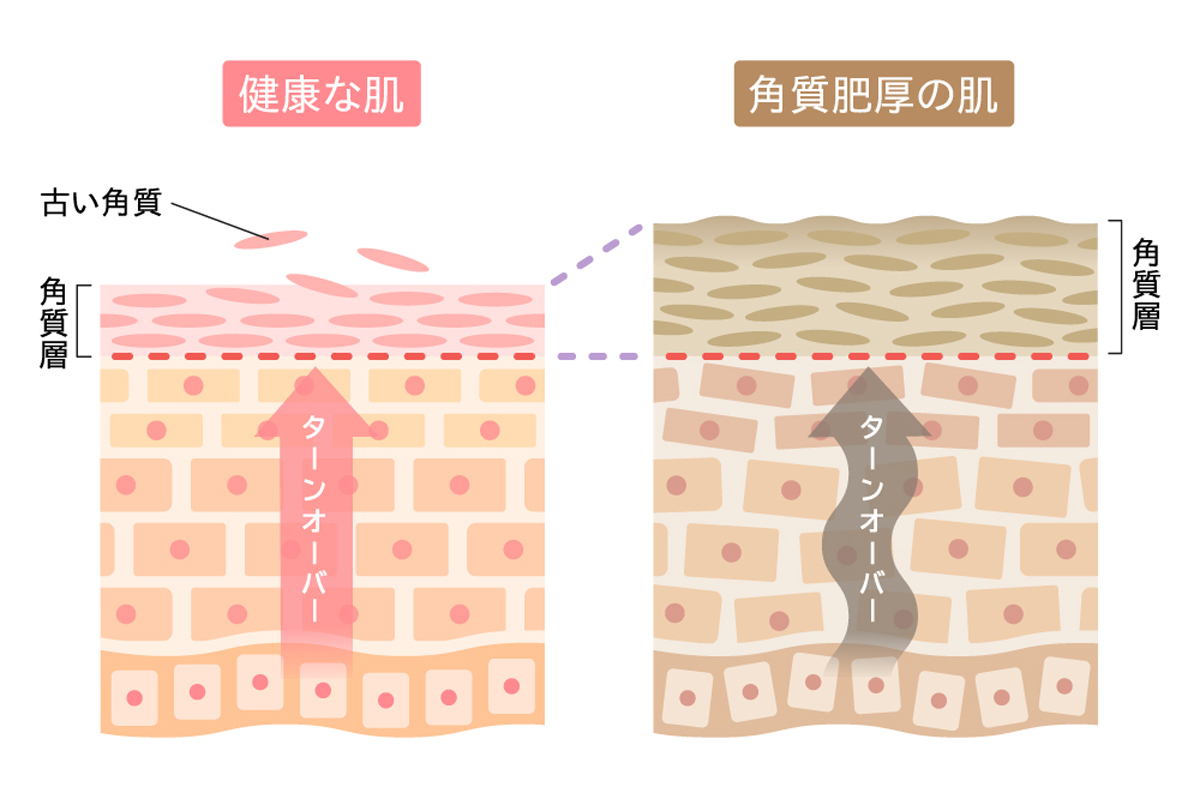 健康な肌と角質肥厚の肌の差を表したイラスト。左には健康な肌で古い角質が剥がれターンオーバーが正常な様子、右はターンオーバーが乱れ角質肥厚を起こし角質層が厚くなってくすんでいる様子をそれぞれ示している。