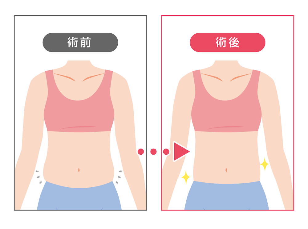 脂肪溶解注射でお腹痩せできる？効果的な通い方と回数、デメリットについて