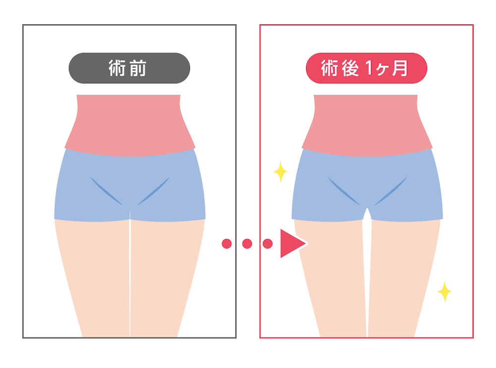 脂肪溶解注射の太ももへの効果は？必要な回数や費用について解説