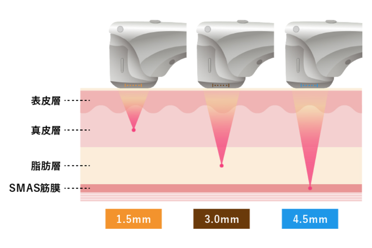 医療ハイフの照射が肌の内部のどの層に作用するかを表したイラスト。真皮、脂肪層、SMAS筋膜に作用していることがわかる