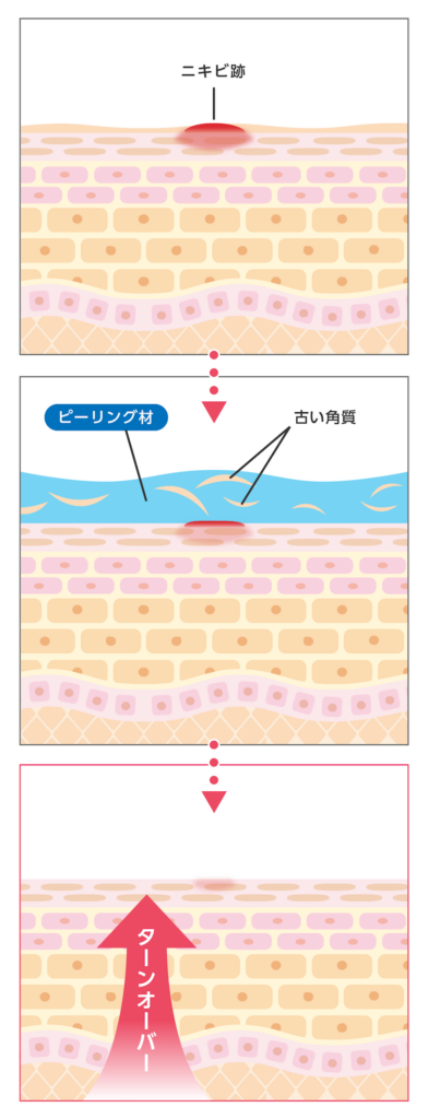 ケミカルピーリングでニキビ跡を治すには何回必要？通う頻度についても解説