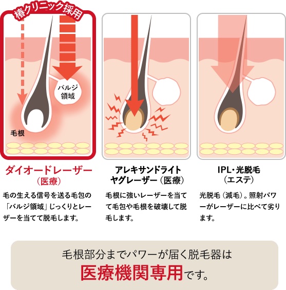 医療脱毛なら顔にも効果ある？必要な回数や費用、脱毛機の選び方