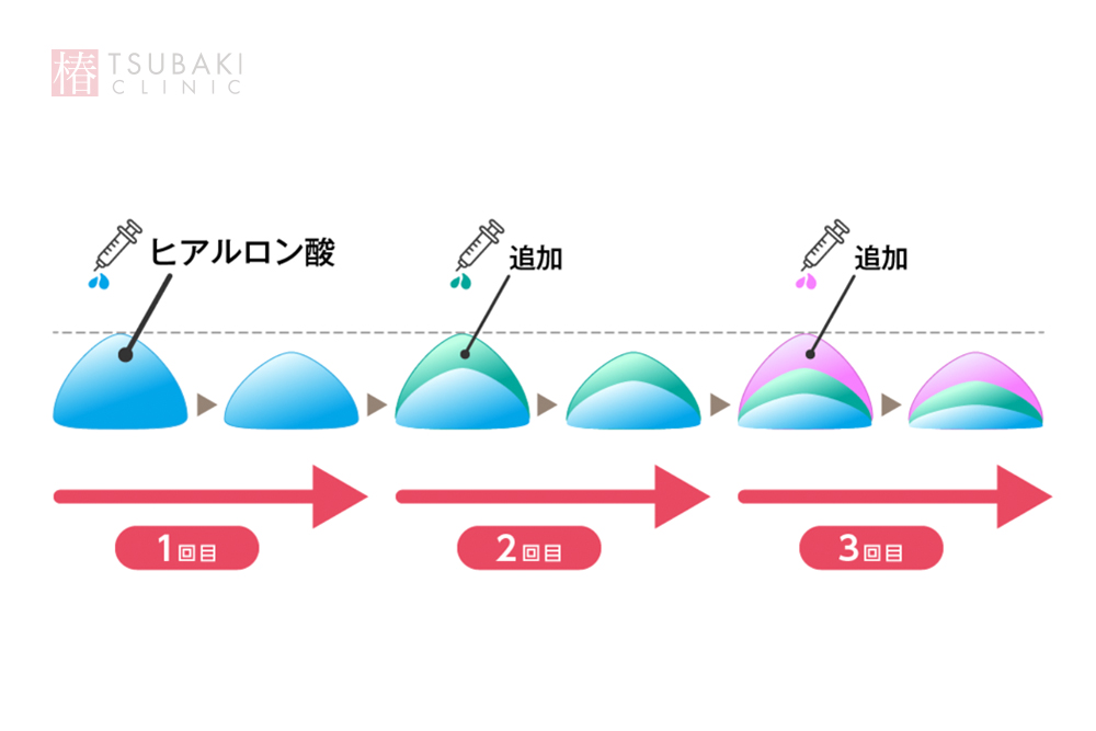 ヒアルロン酸注射の効果期間！顔はどれぐらい効果が持続するのか解説