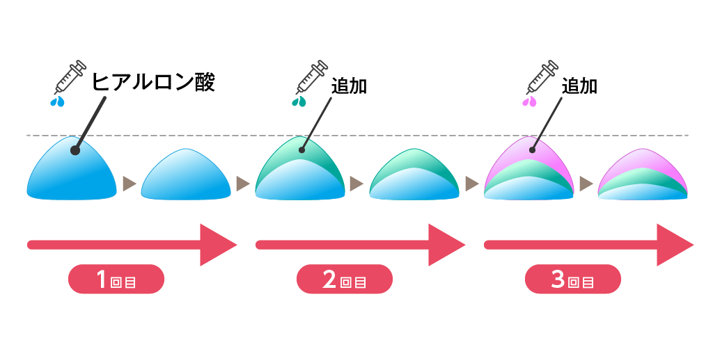 鼻ヒアルロン酸は何回までなら横に広がらない？持続期間やヒアルロン酸注射の選び方