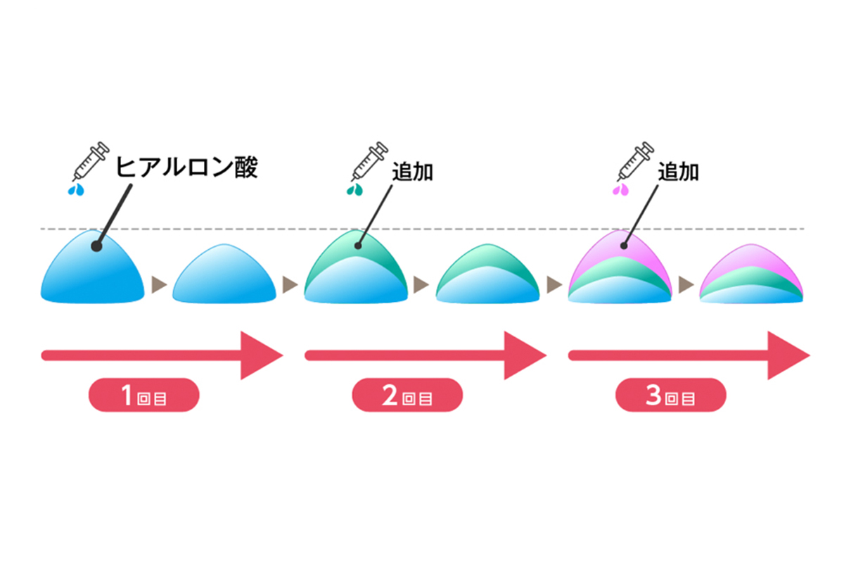 ヒアルロン酸注入による積み重なり具合を表したイラスト。左から順に1回目・2回目・3回目と回数を重ねるごとにヒアルロン酸が重なり、追加の注入が少なくていいことがわかる。