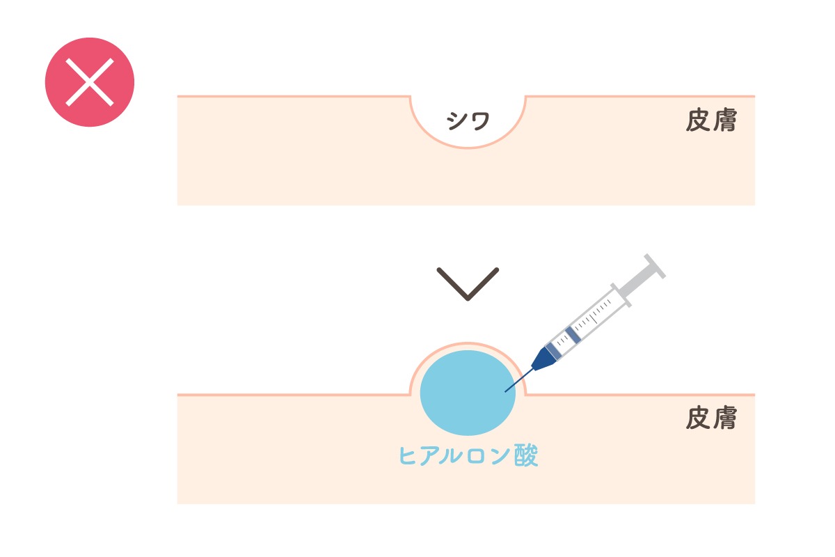 ヒアルロン酸の注入に関してNGな入れ方を表したイラスト。肌を縦の断面で描いており、シワの部分が盛り上がるように注入している。
