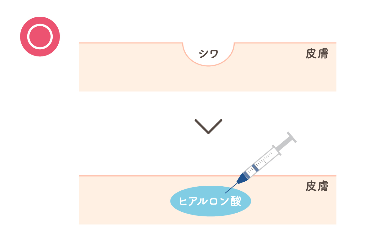 ヒアルロン酸注入によるシワの改善の様子が肌の断面から描かれたイラスト。シワの溝の部分に平らになるようにヒアルロン酸を注入している様子。