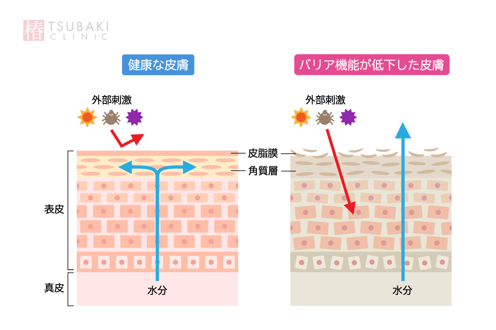 健康な肌とバリア機能が低下した肌