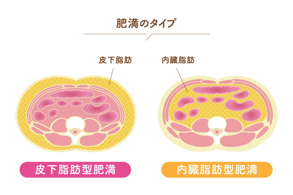 皮下脂肪型肥満と内臓脂肪型肥満の違いを示した断面図のイラスト
