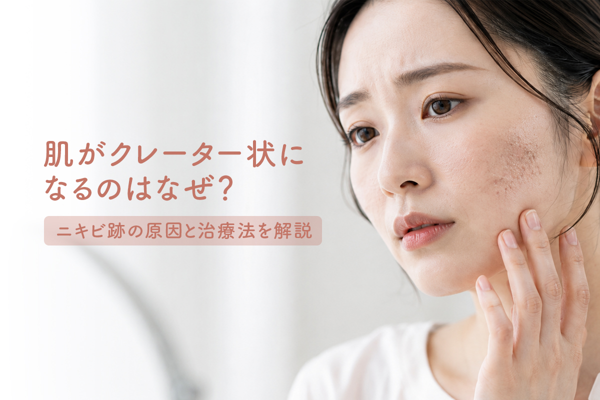 肌がクレーター状になるのはなぜ？ニキビ跡の原因と治療法を解説