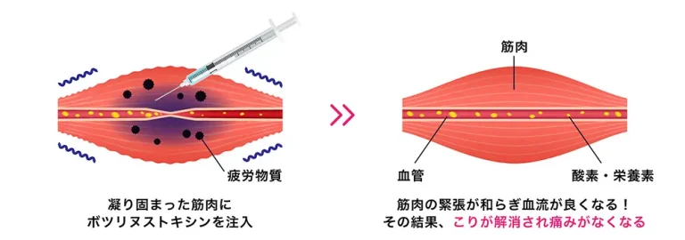 肩こりを解消する施術説明