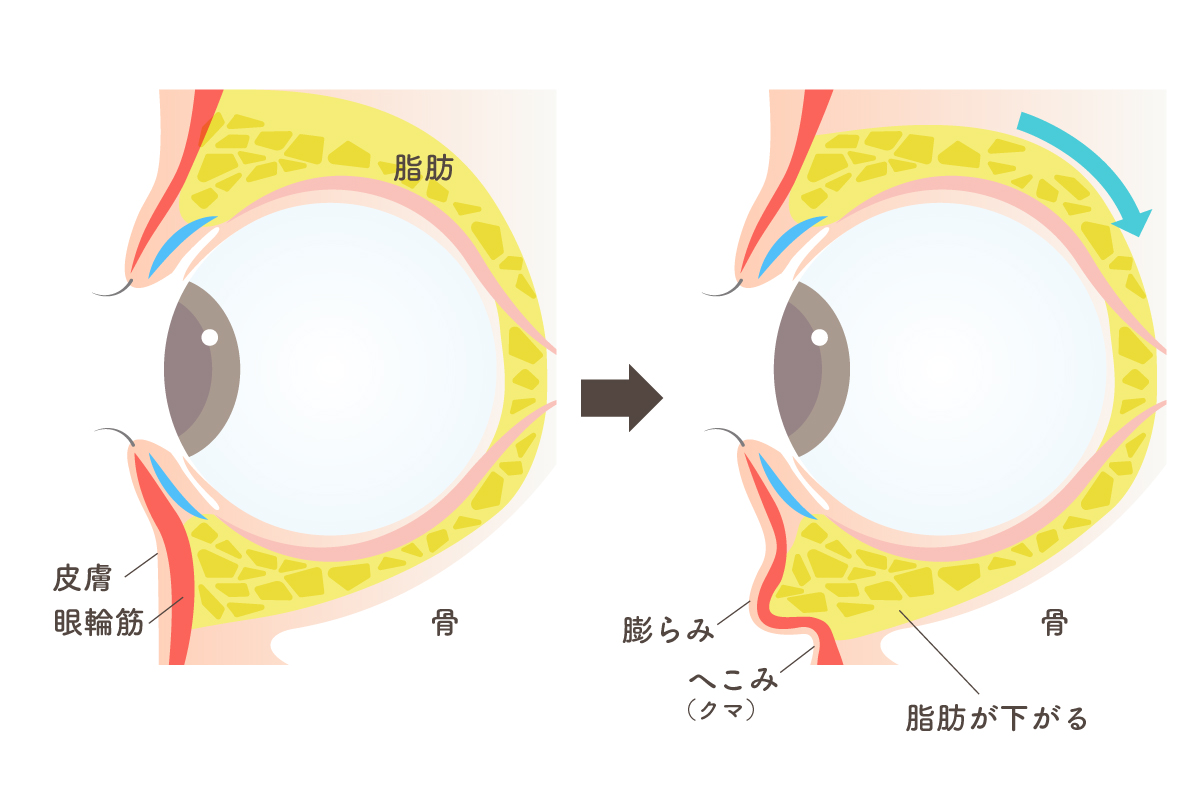 目の下の膨らみやクマを目周りの断面図のイラストで解説している。目の周りを囲む脂肪が下がり、眼輪筋のハリが低下することで目の下のふくらみとして現れ、さらにその下ではへこみがクマとして現れる。