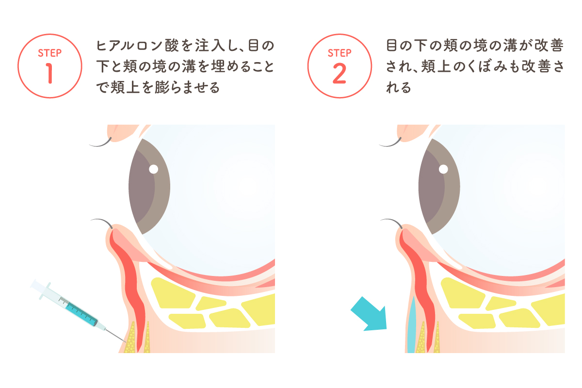 目の下のヒアルロン酸注入の様子を目の断面図で表したイラスト。目の下のへこみの部分にヒアルロン酸注入を行うことで、滑らかなふくらみを取り戻す様子を描いている。