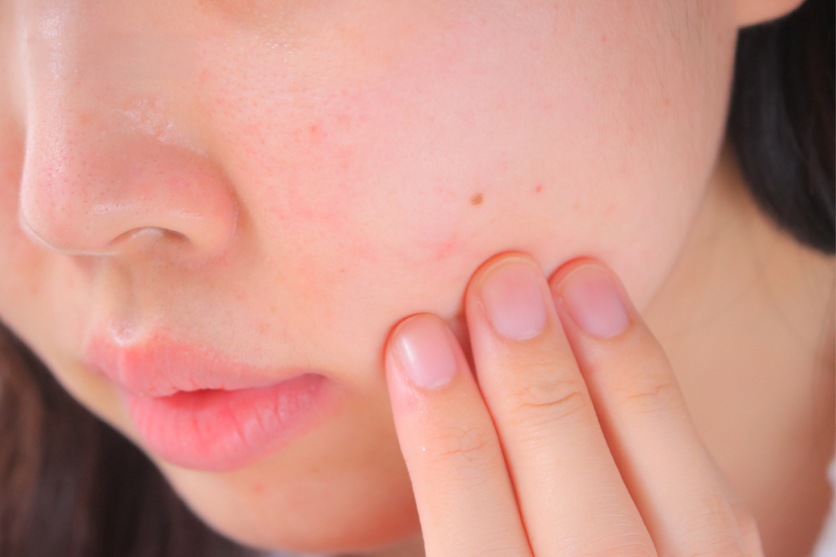 女性が頬の赤みに手を触れているアップの構図の実写写真。