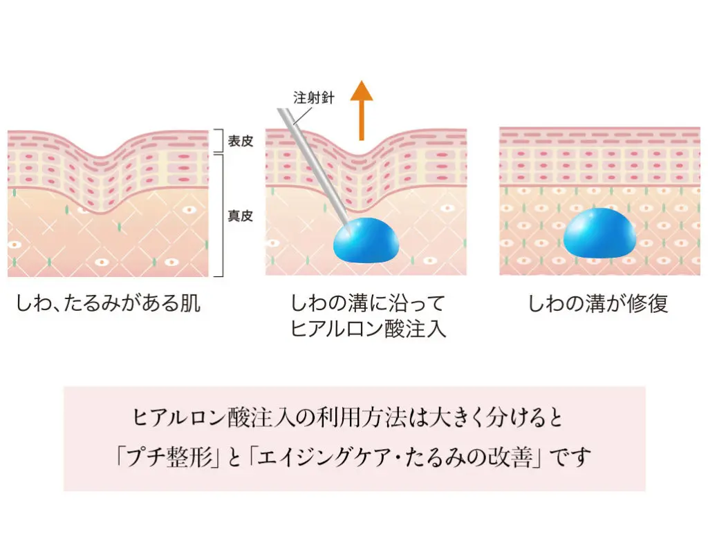 ヒアルロン酸注入でできること