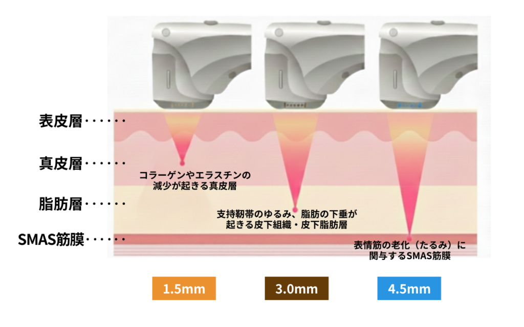 ハイフ（HIFU）の照射深度のイメージ図。1.5mmは真皮層、3.0mmは皮下組織、4.5mmはSMAS筋膜にアプローチし、たるみの原因となる層に熱エネルギーを届ける。