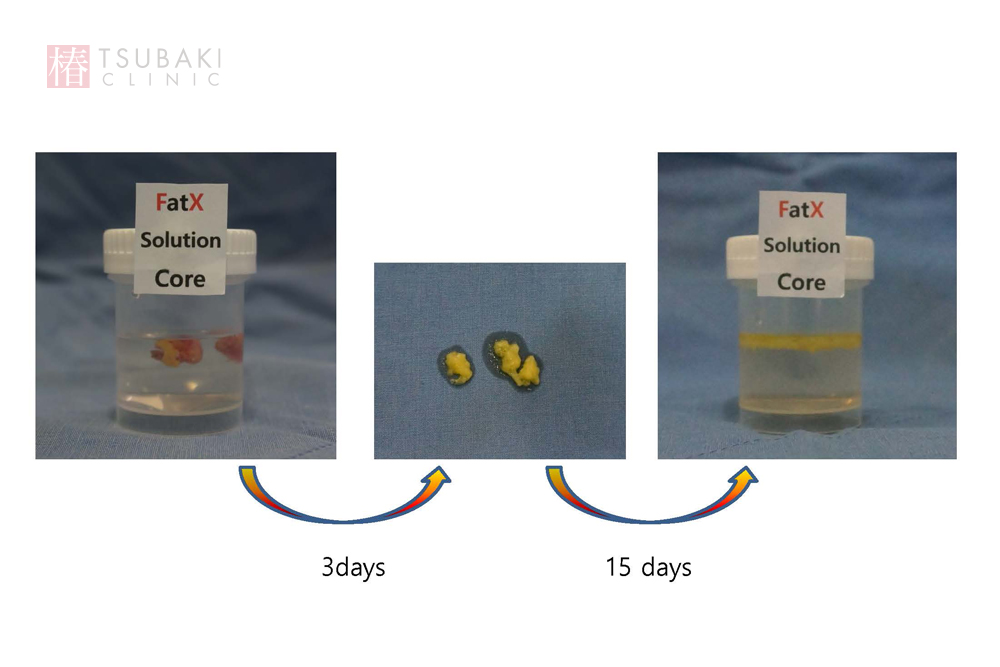 FatX coreの施術後の経過：日々の変化