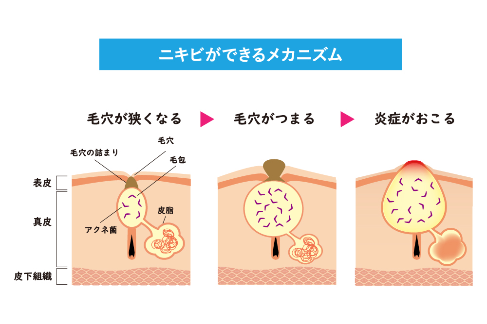 赤みのあるニキビも消すことができる？イソトレチノインの治療ガイド