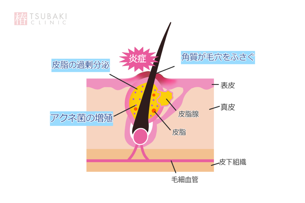 ストレスとニキビの関連性