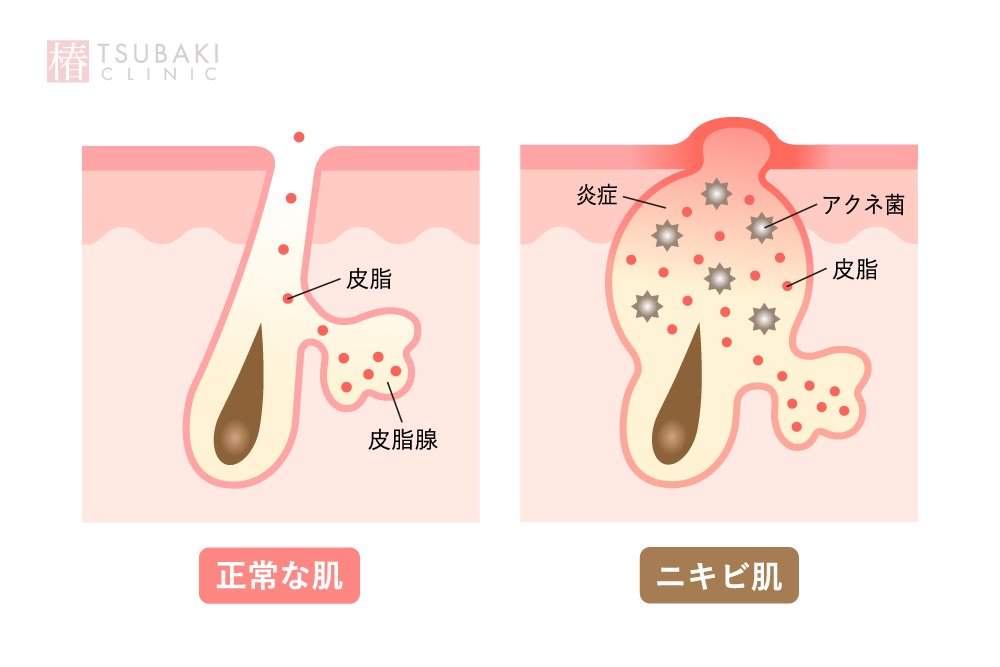 イソトレチノインでしつこいニキビを克服！その効果と治療法を徹底解説します