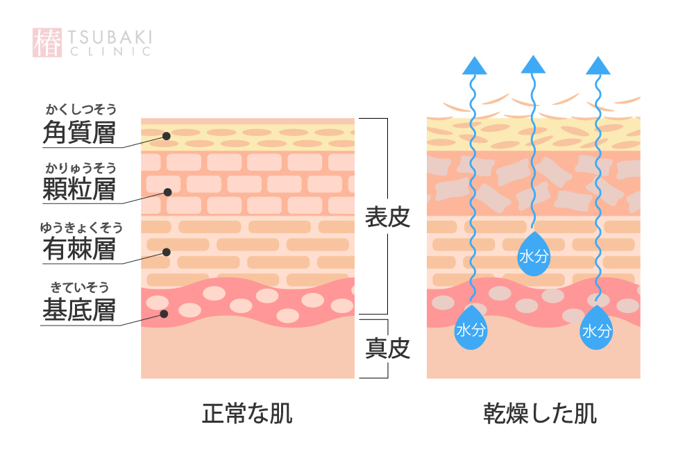 ストレスとニキビの関連性