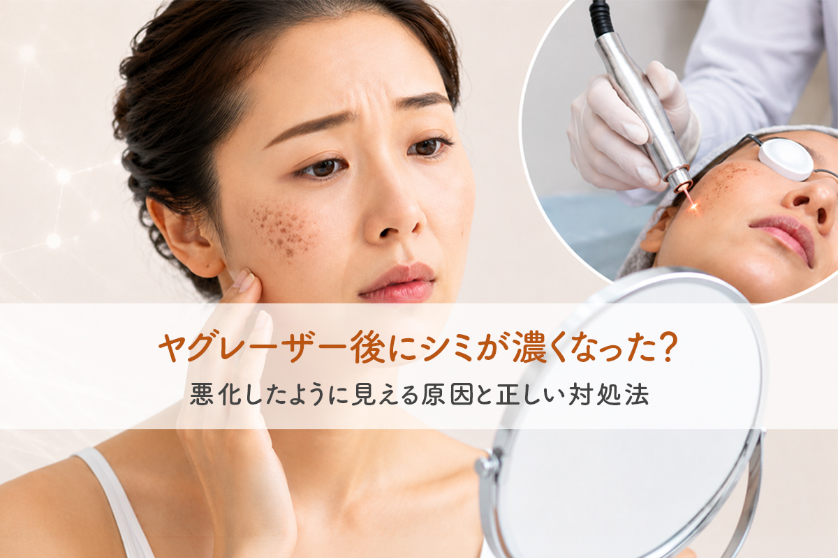 女性が鏡を見ながら頬のシミを気にするような表情で肌に触れており、右上にはレーザーによるシミ治療を受けている様子が円形の枠内に表示されている。「ヤグレーザー後にシミが濃くなった？悪化したように見える原因と正しい対処法」というタイトルの入った美容医療コラムのメインビジュアル。