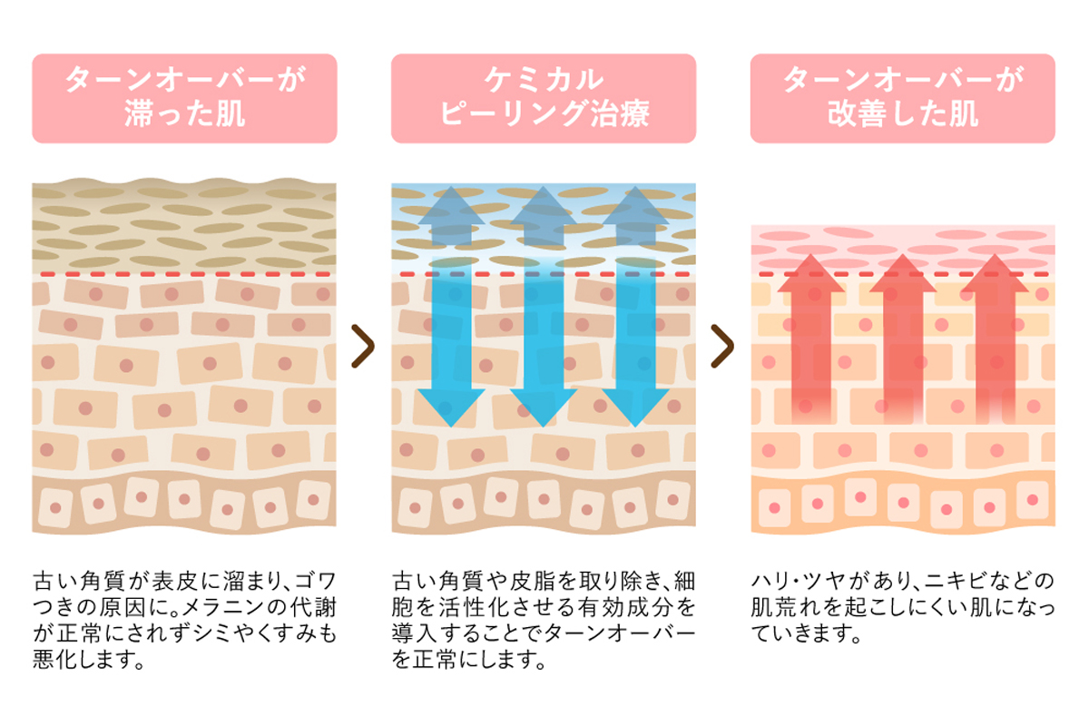 ケミカルピーリングによる肌のターンオーバーの改善を肌の断面図のイラストで表している。左から順にターンオーバーが滞り角質が肥厚した状態、ケミカルピーリングによって角質が取り除かれ成分が肌内部に浸透している状態、ターンオーバーが改善し角質が整った状態を示している。