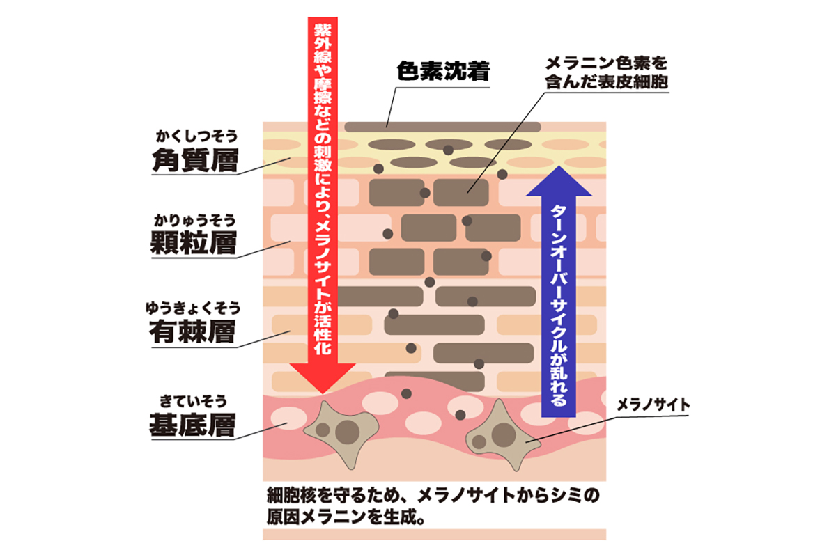 色素沈着ができる様子を肌の断面図のイラストで説明している。紫外線などの刺激で基底層のメラノサイトが刺激され、細胞核を守るためメラニンを生成。ターンオーバーサイクルが乱れることでメラニンが有棘層、顆粒層、角質層と積み重なり、肌表面に色素沈着として現れている。