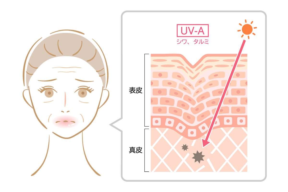 シワの多い女性と肌の断面図でUVAのダメージ深度について書かれたイラスト。肌の断面図では太陽からの紫外線が真皮層にダメージを与え、表皮にかけてシワを作る様子が描かれている。