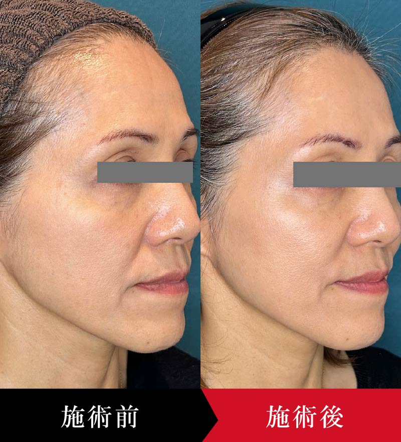 ヒアルロン酸注入