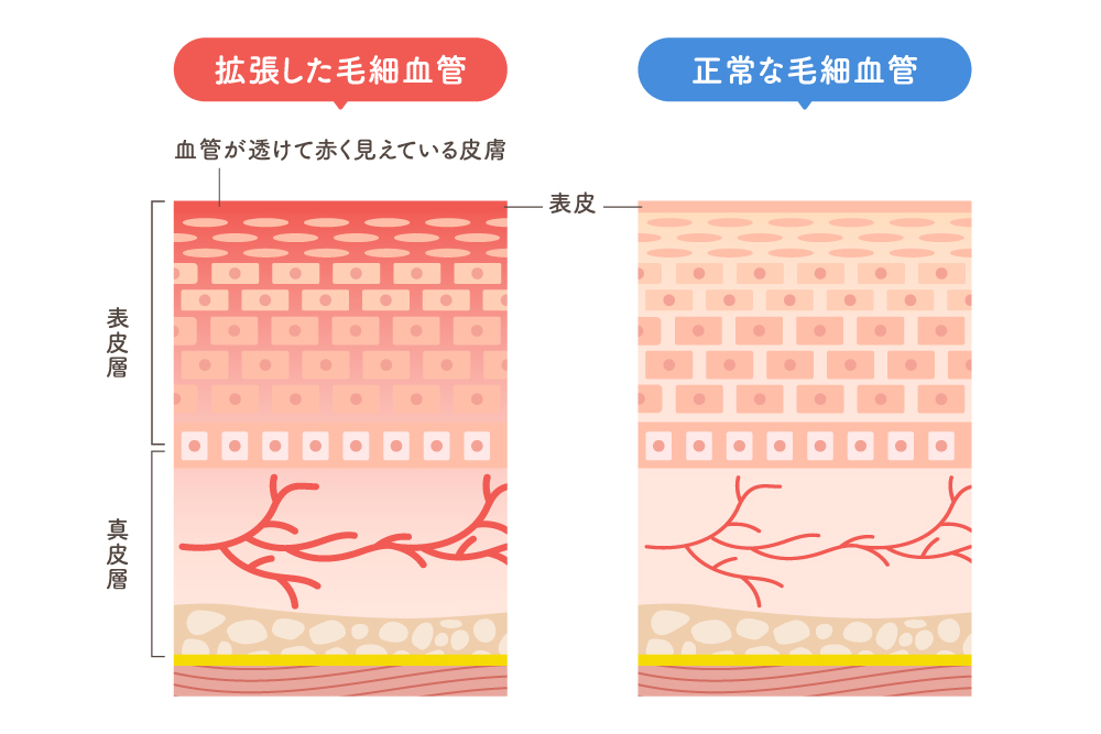 掻きむしった後に赤くなったり、茶色っぽく色素沈着になったりして、残った跡が気になる人も多いのではないでしょうか。掻きむしり跡を目立たなくさせるためには、日々のスキンケアが重要です。まずは掻きむしり跡ができる原因について見ていきましょう。
掻きむしり跡が残る原因とは?肌への影響を解説
掻きむしり跡が残る原因は、皮膚に強い摩擦が起き、長時間炎症が起きていたことが原因です。
掻きむしり跡には、赤みの残るものと、色素沈着として残るものの2種類があります。赤みの残る掻きむしり跡は、部分的に長時間炎症を起こし、その炎症を鎮めようと毛細血管が拡張することで起こります。特に顔の皮膚は薄く血管が透けて見えやすいため、拡張した毛細血管が集まると皮膚表面から見たときに、赤みが残って見えてしまいます。