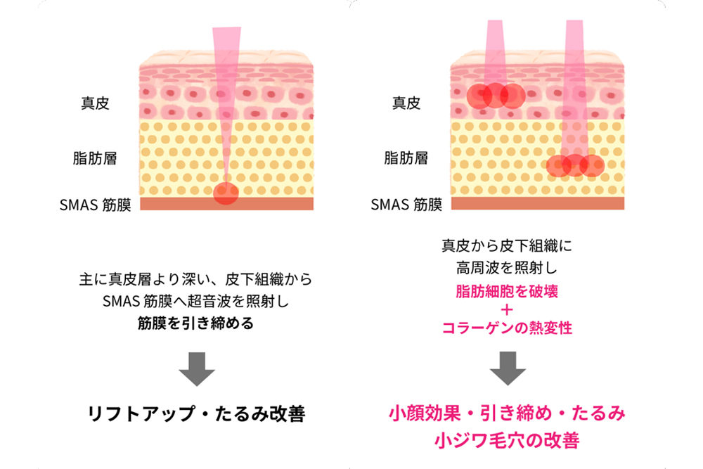 医療ハイフとインモードの違い