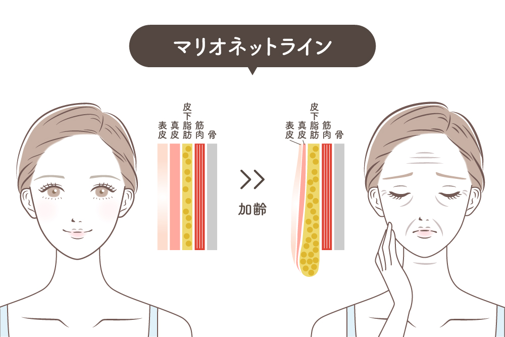 マリオネットラインが形成される皮膚の状態