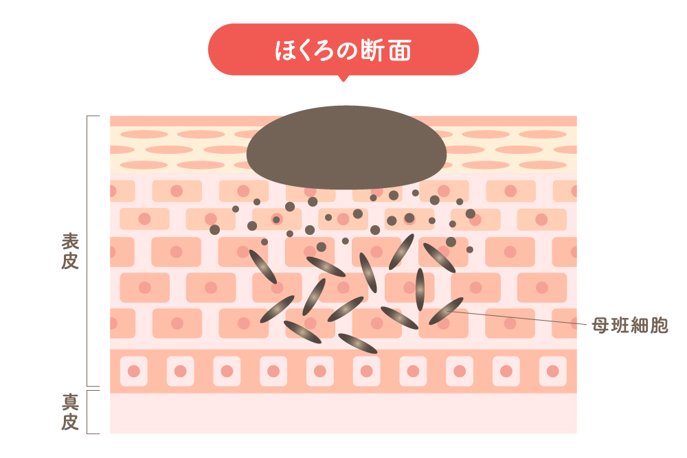 ほくろの断面