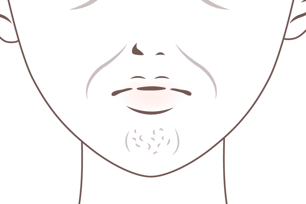 顎の梅干しじわ