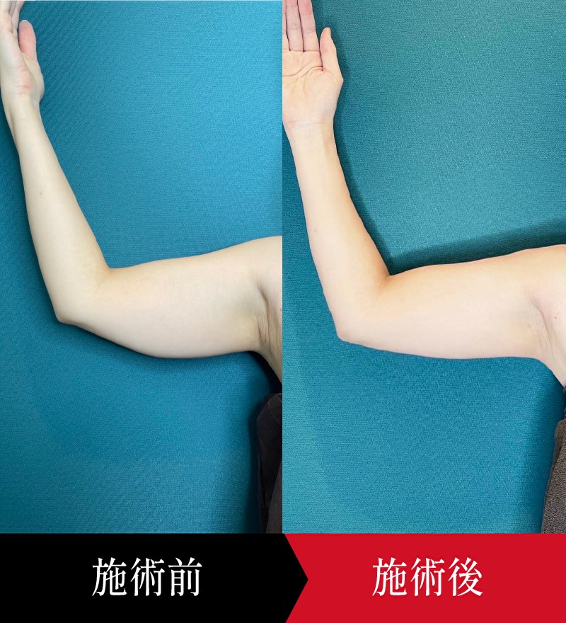 脂肪溶解注射（体）