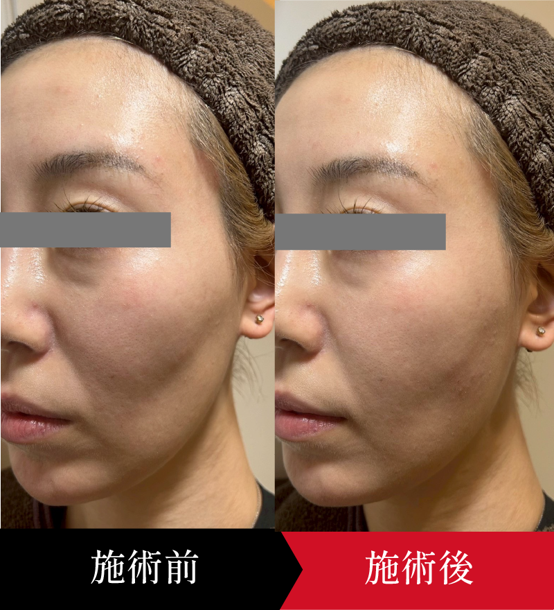 ヒアルロン酸注入