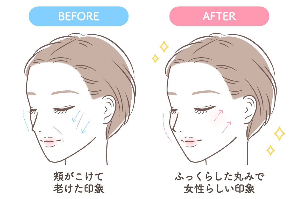 頬がこけた老け見えのBeforeと、ふっくら丸みが出たAfterを比較したイラスト。頬骨下のへこみ改善のビフォーアフター図