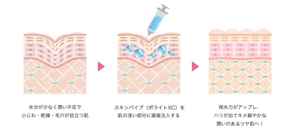スキンバイブ(ボライトXC)の注入層と効果を表した肌断面のイラスト。