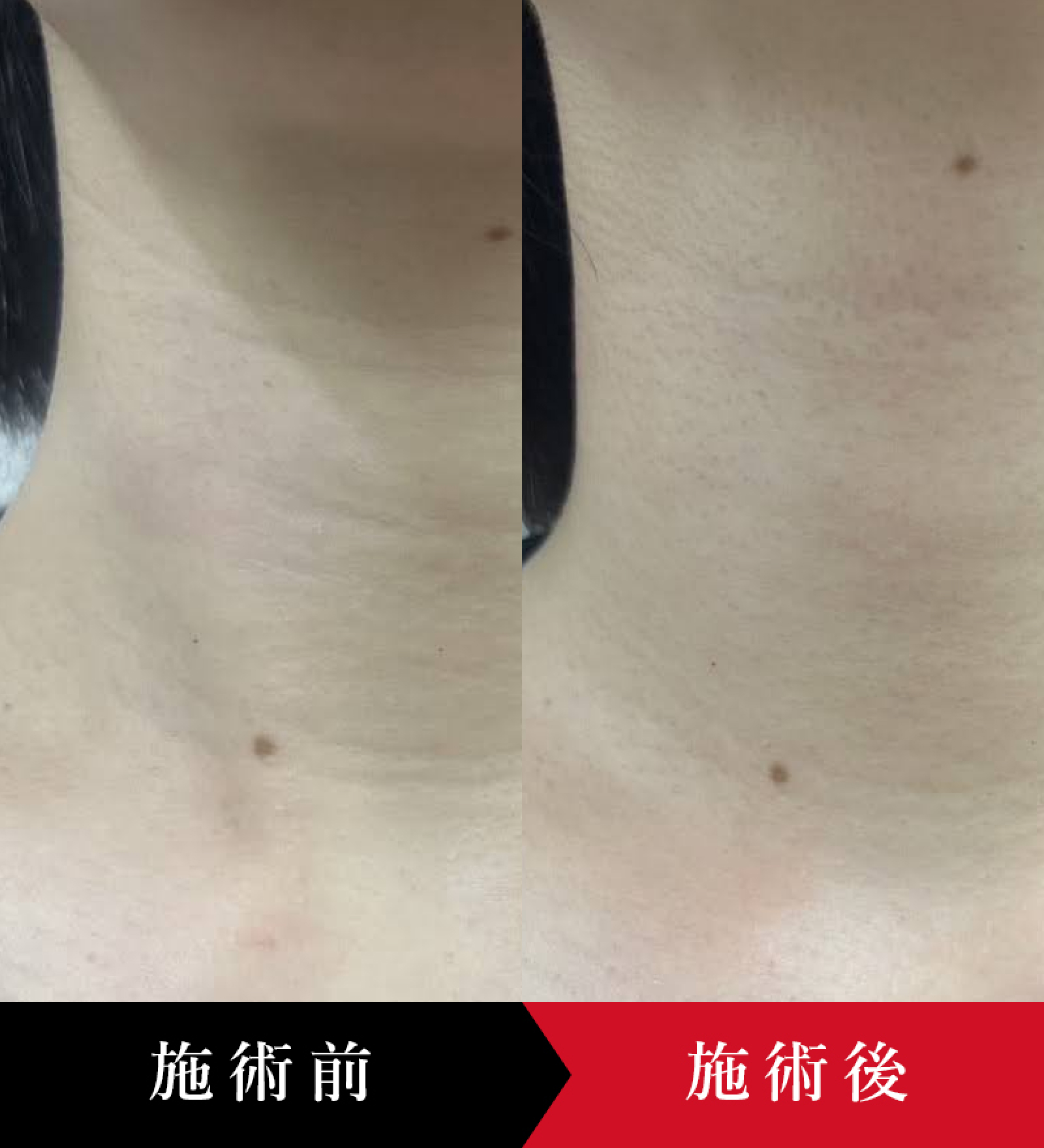 首のボライト施術前と施術後を比較したビフォーアフター写真。肌の質感の変化を確認できる画像